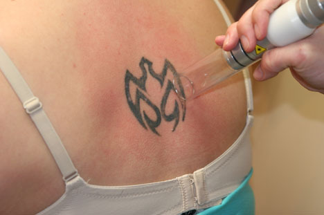 How a Laser Tattoo Removal Works